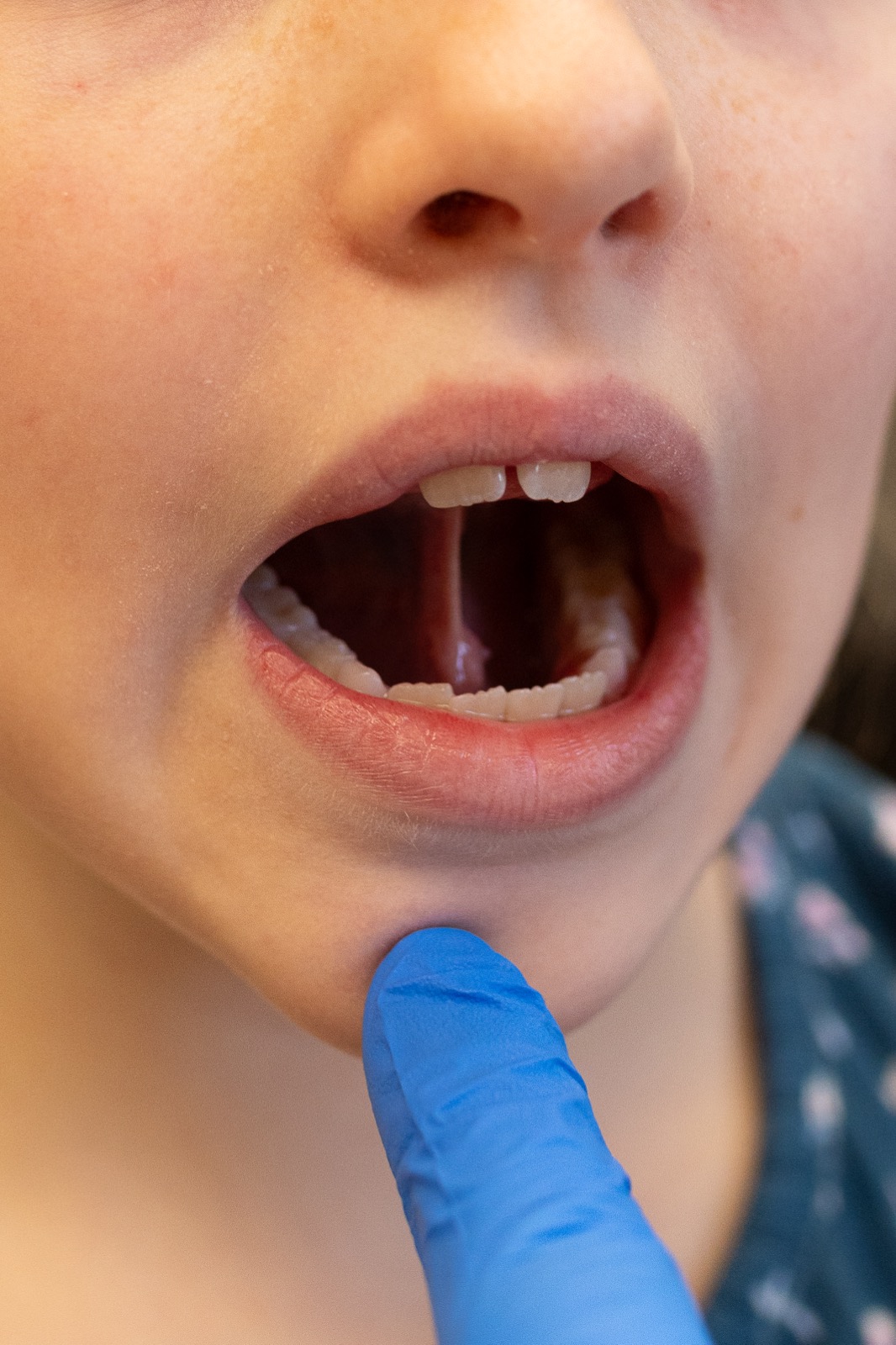 A child with mouth open during an oral evaluation